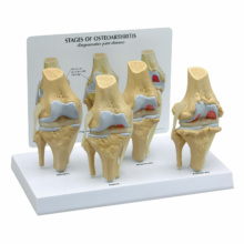 変形性膝関節症，4段階モデル