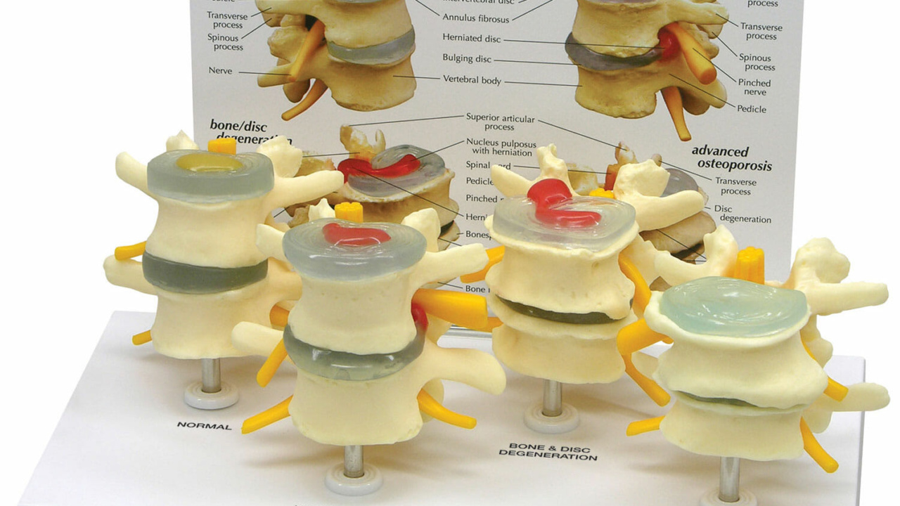 腰椎疾患モデル，4種セット | 日本スリービー・サイエンティフィック