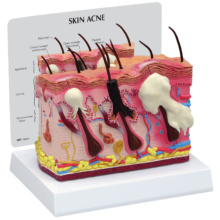 ニキビ皮膚モデル