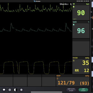 異所性と電気的ノイズが乗ったII 誘導波形（Defibrillator Screen Simulation）
