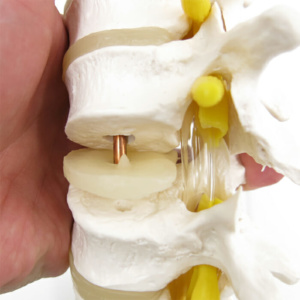 椎体の中に銅線が通っています