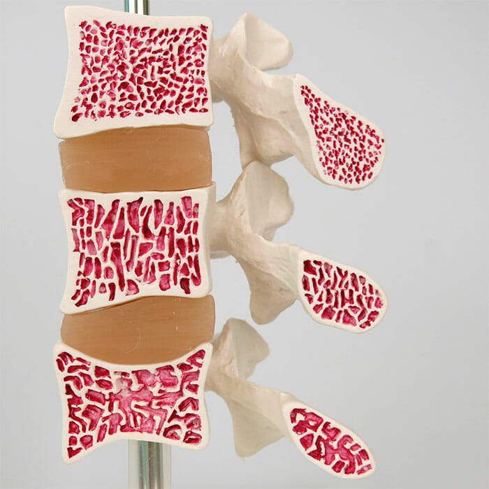 骨粗鬆症モデル，3段型 | 日本スリービー・サイエンティフィック