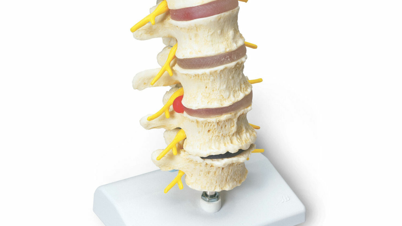 ヘルニア a795-1280x720.jpg