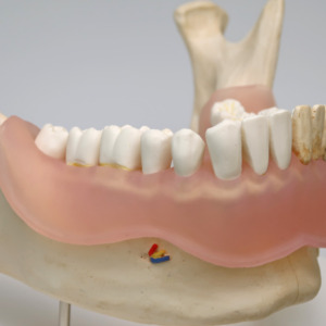 右側の歯は正常な状態を再現しています