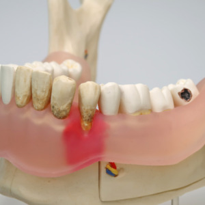 左側の歯では虫歯や歯周炎などの疾患を再現しています