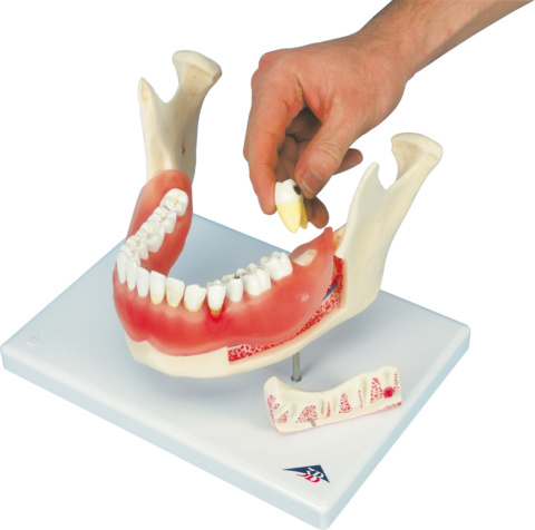 歯と歯茎の疾患モデル
