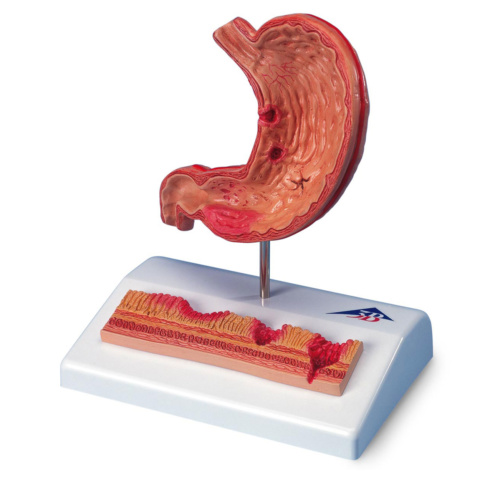 胃潰瘍モデル