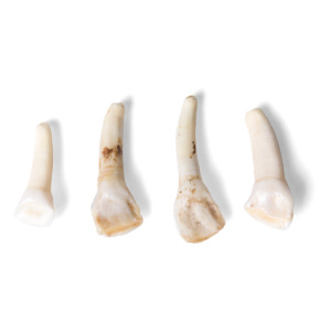 歯の標本例7