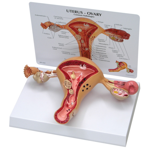 子宮と卵巣の疾患モデル