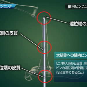 髄内ピンニング 2