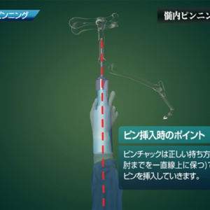 髄内ピンニング 3