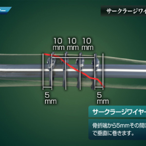 サークラージワイヤーによる補強