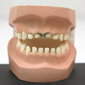 中度の虫歯