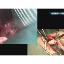 イヌの椎間板ヘルニア 造窓術と片側椎弓切除術
