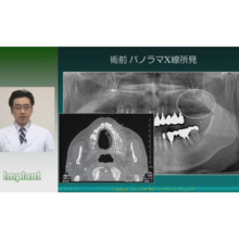 口腔外科医と学ぶ 「 フィクスチャー埋入術 」