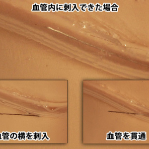 穿刺状態が裏側から確認できます