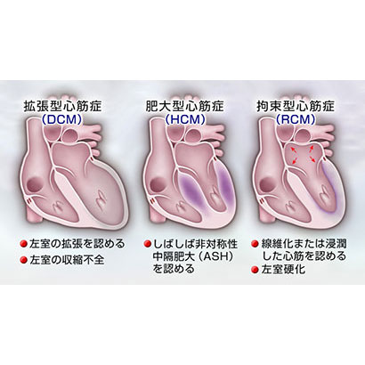 心筋疾患