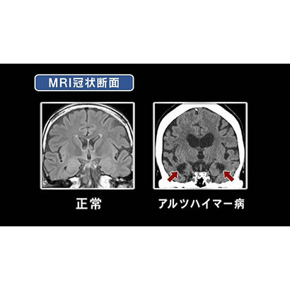 認知症