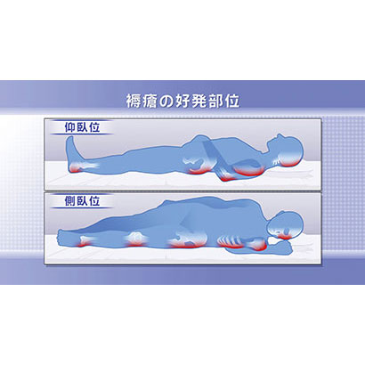 皮膚ケアを必要とする療養者の看護